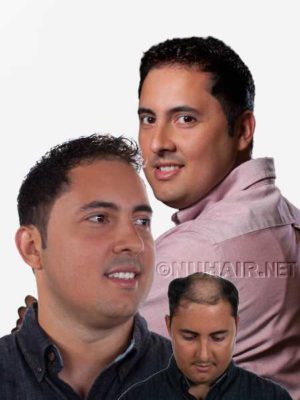 Men's Hair Replacement System Hair Restoration for Male Hair Loss DFW Texas