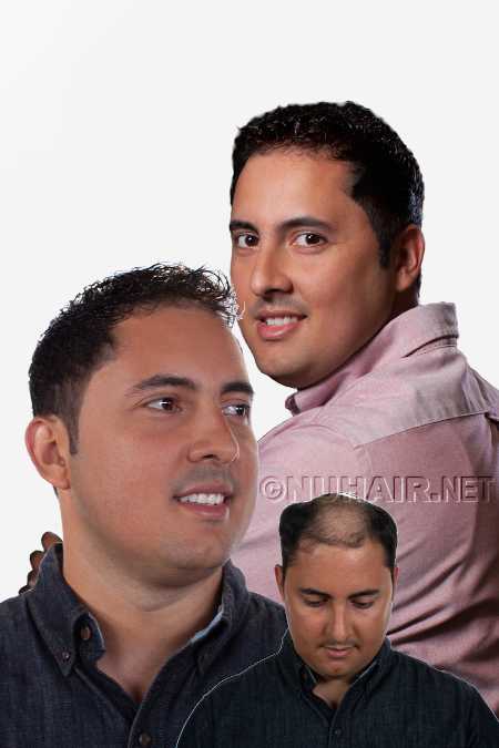 Men's Hair Replacement System Hair Restoration for Male Hair Loss DFW Texas