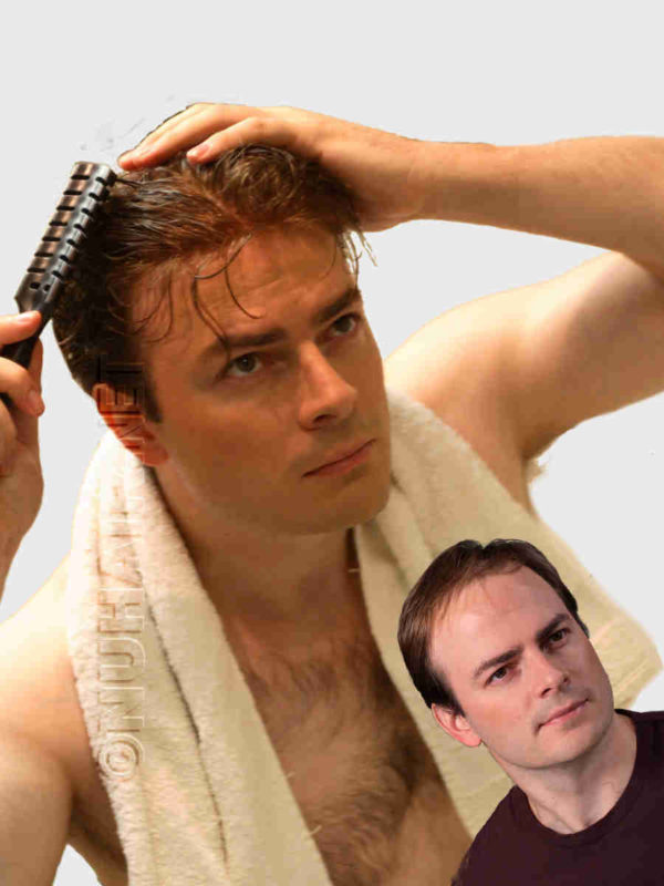 Best Hair Replacement System For Men's Hair Loss in Dallas, TX