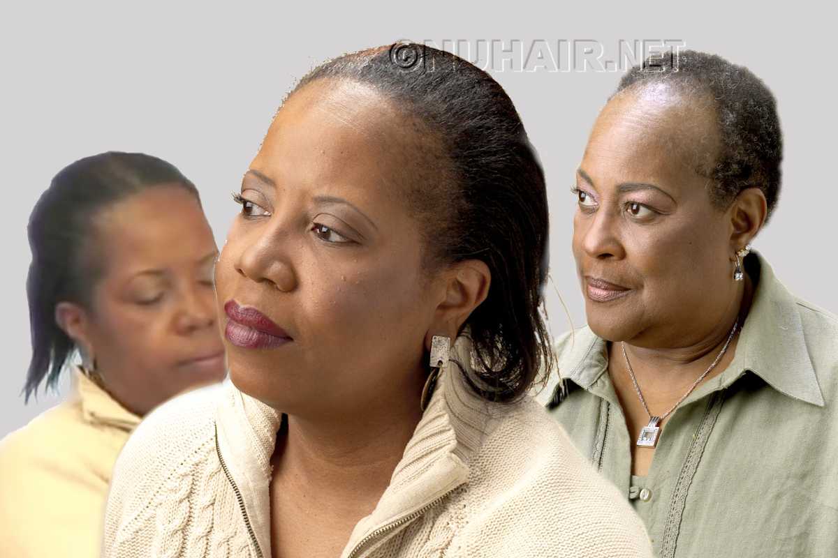 Black Women Hair Extensions Weaving Cause Hair Loss Traction Alopecia