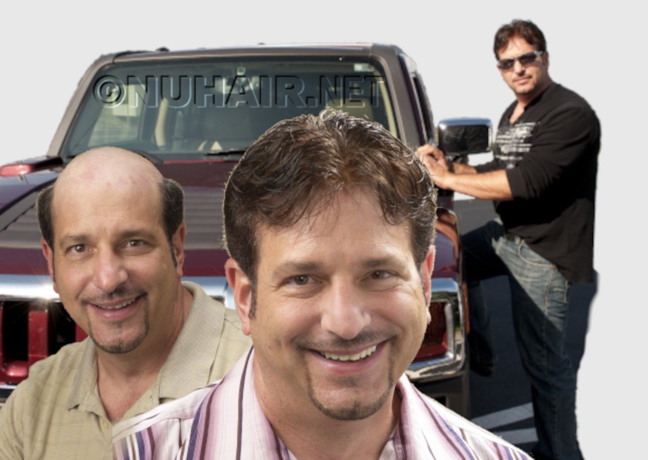 Man Hair Restoration Dallas Hair Replacement Services DFW